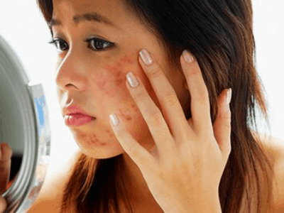 girl struggling with a lot of acne