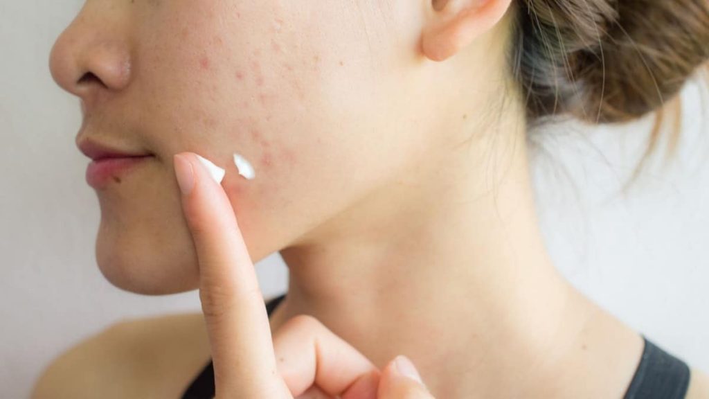 The Lazy Easy Acne Skincare Routine To Change Your Skin